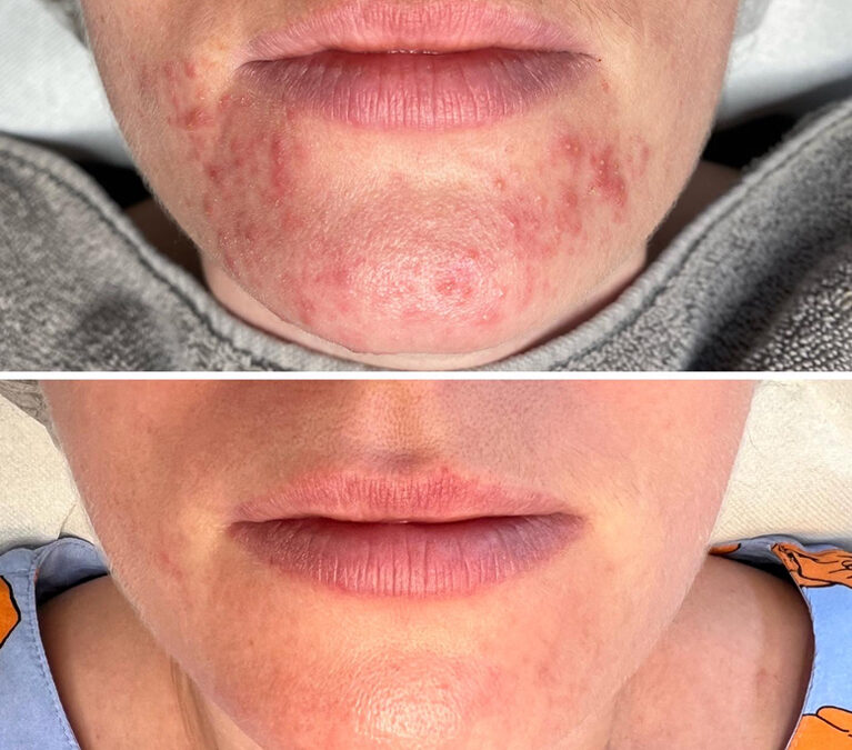 Perioral dermatitis