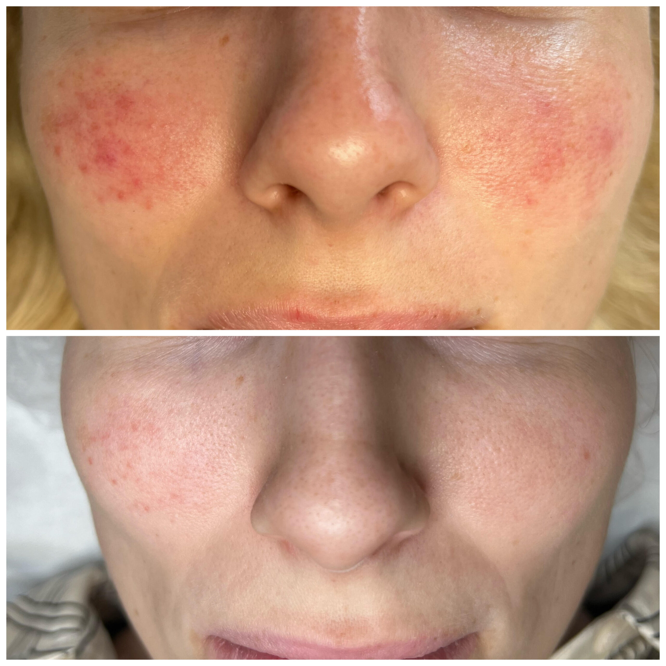 Rosacea behandling 3